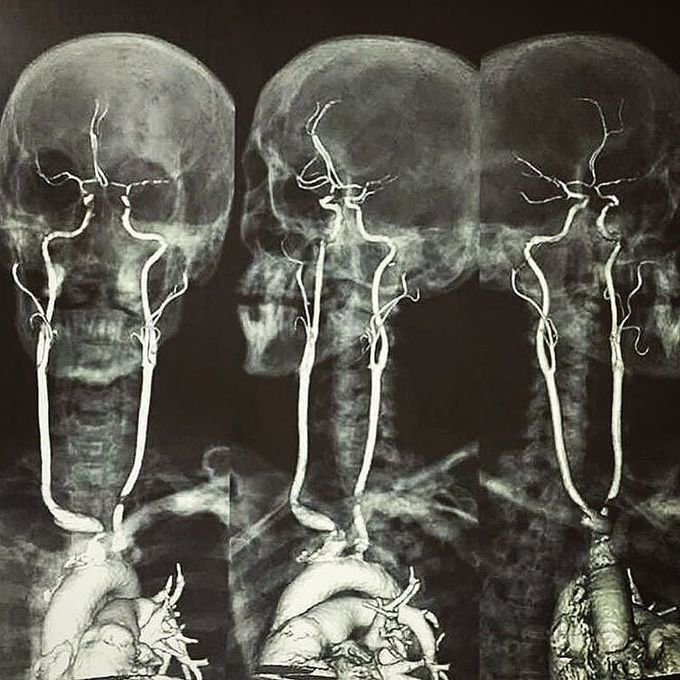 Carotid artery