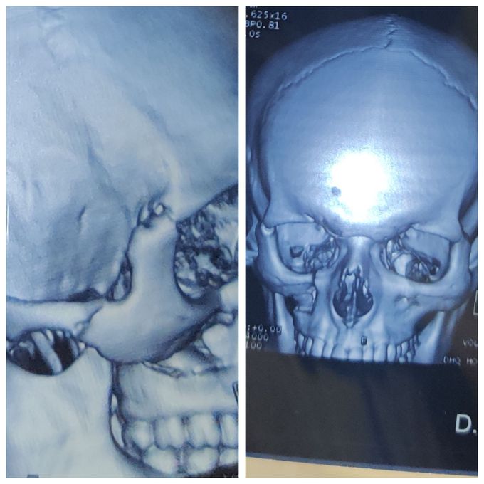 ZMC Fracture