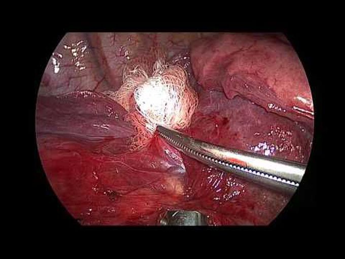 Right Lower Lobe Superior Segmentectomy for Metastatic Colorectal Cancer