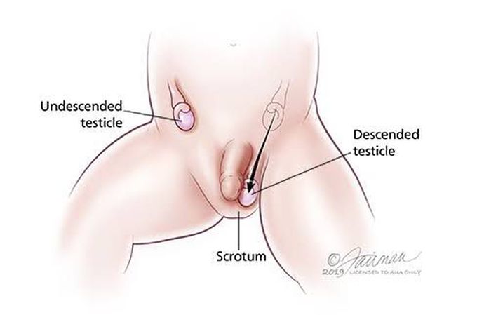 Undescended Testes