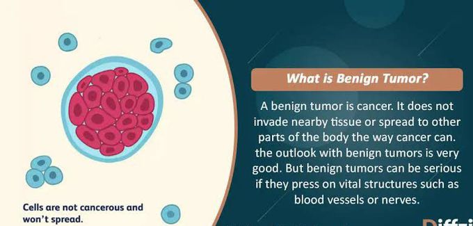Benign tumor
