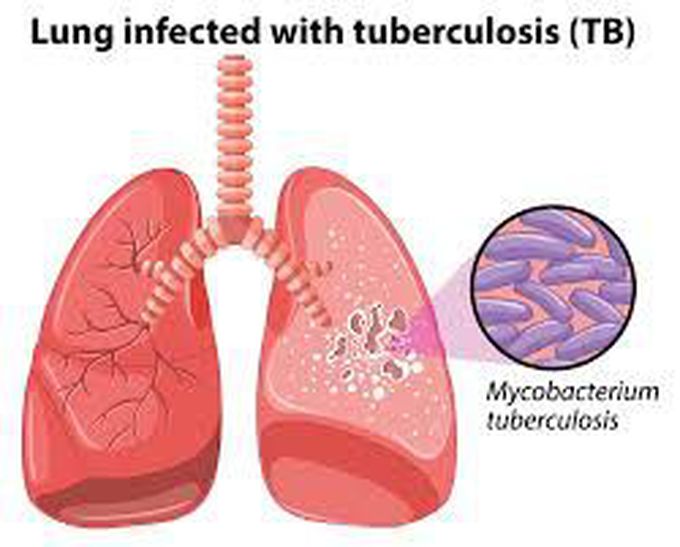 How is tuberculosis treated?