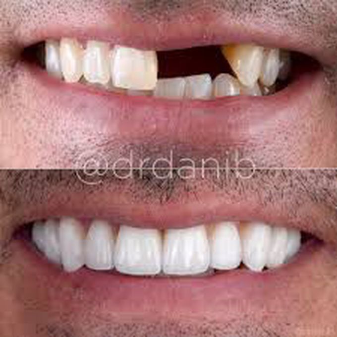Advantages of poreclain teeth