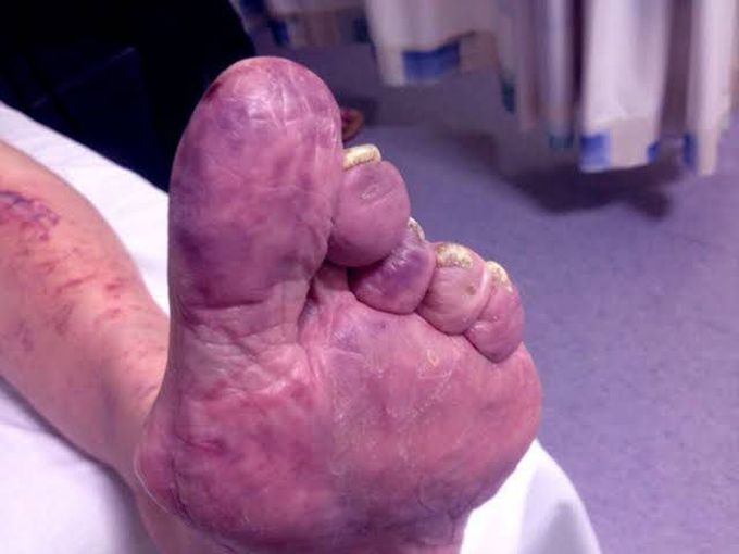 Purple Toe Syndrome- Warfarin related