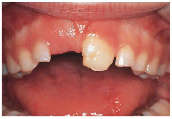 Localised dental disturbance caused by prolonged intubation during tooth development.