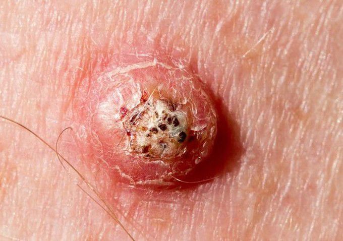 Keratoacanthoma