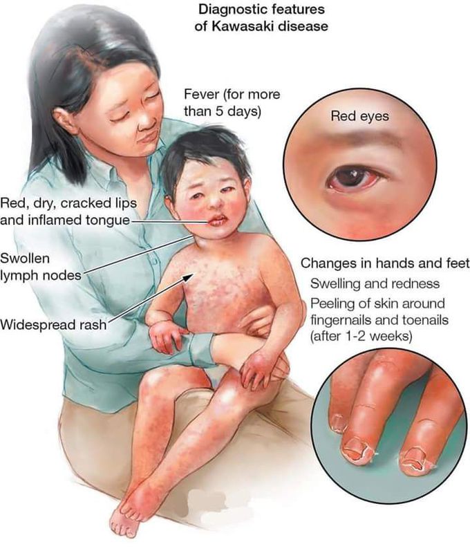 Kawaski disease