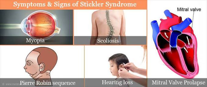 These are the symptoms Stickler syndrome