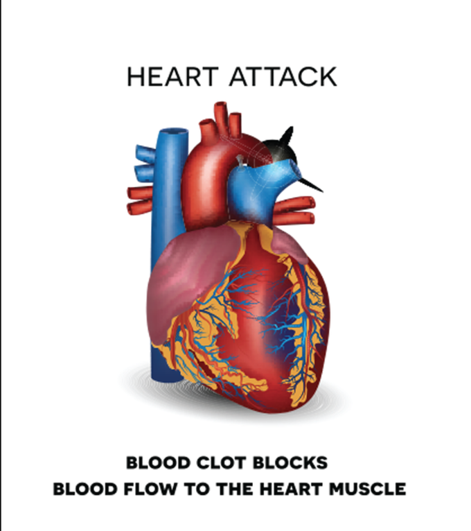 Heart Attack: Cause, Symptoms, Risk Factors, Diagnosis and Treatment.
