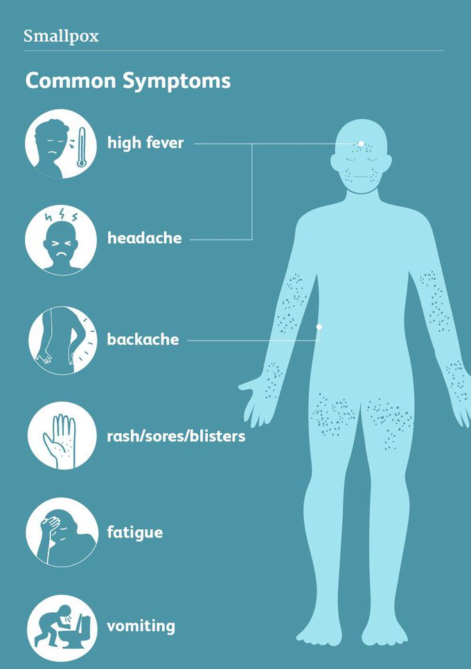 Symptoms of smallpox