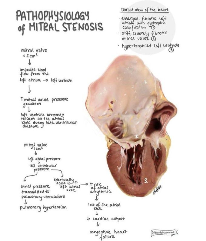 Pathophysiology of mitral stenosis