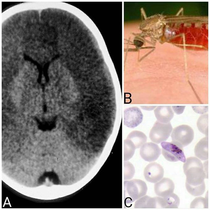 Malaria
