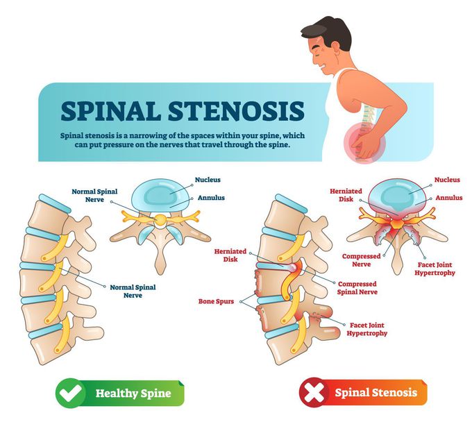 Spinal stenosis