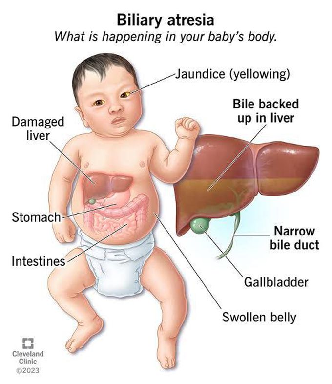 Biliary Atresia symptoms