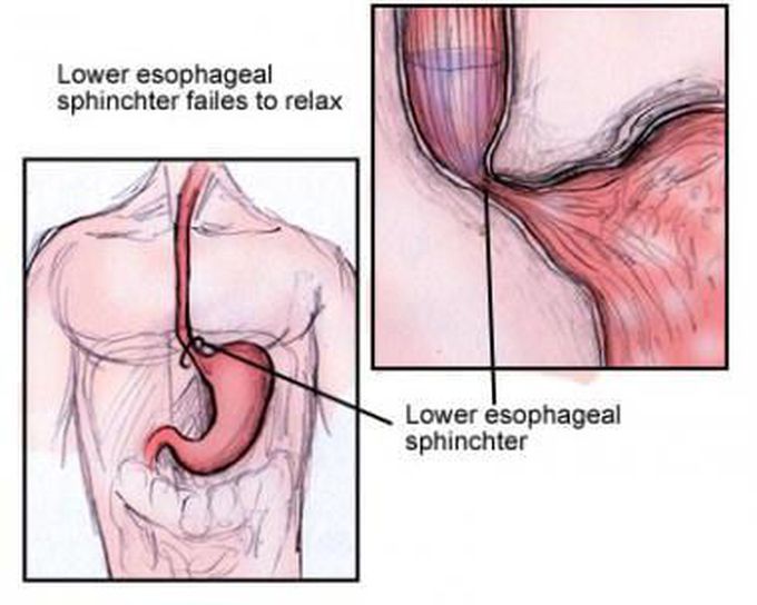 Heller's myotomy