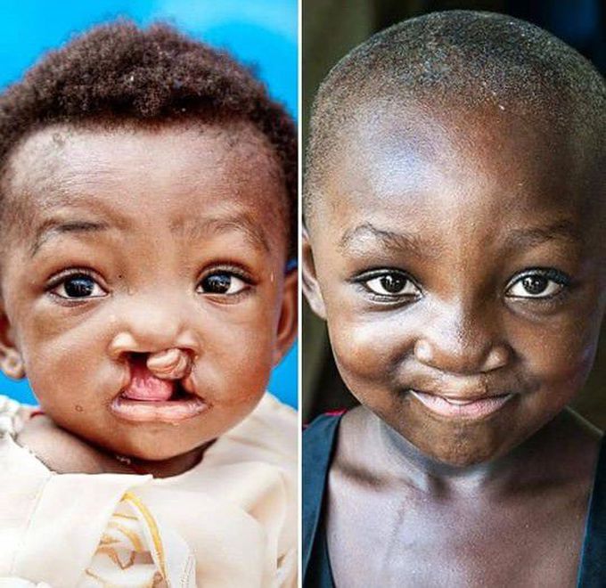 UNILATERAL CLEFT LIP AND PALATE