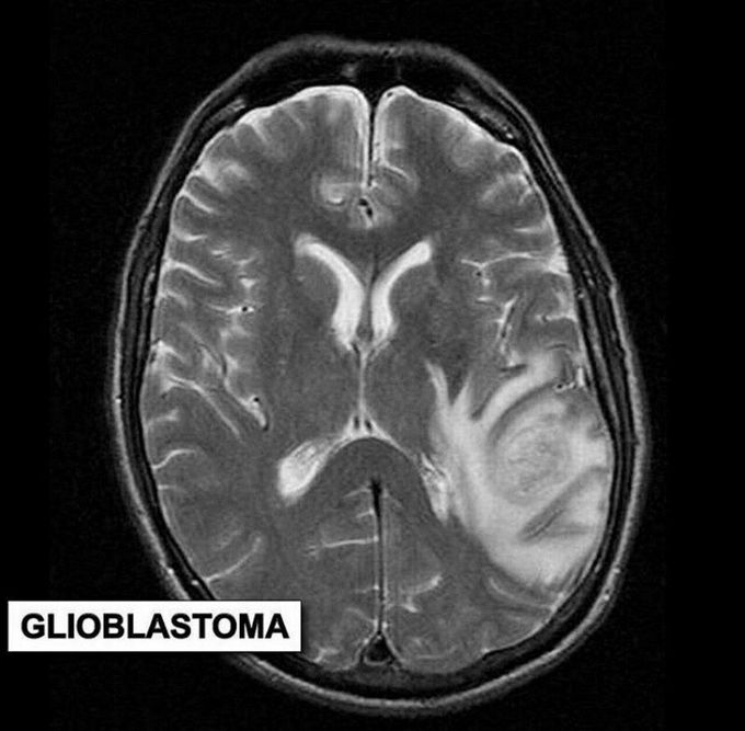Glioblastoma

Glioblastoma, also known as glioblastoma multiforme (GBM), is the most common and most aggressive cancer that begins within the brain.