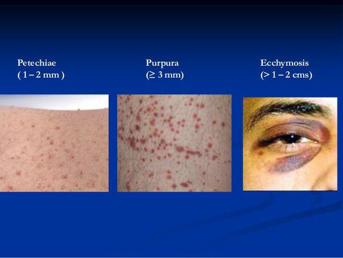 Petechiae vs Ecchymosis vs Purpura