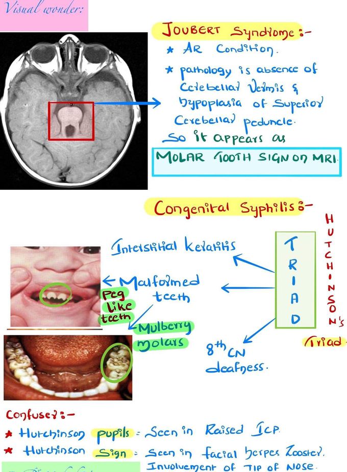 congenital syphilis