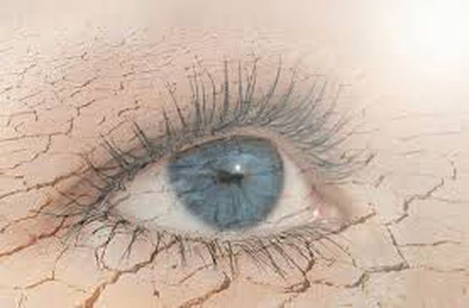 Keratoconjunctivitis sicca (dry eye)