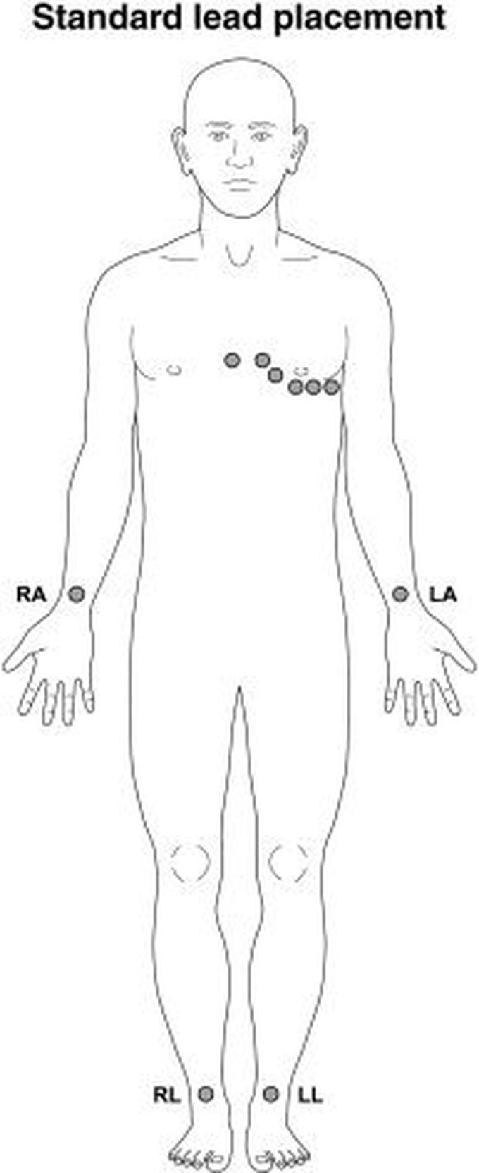 ECG lead placement
