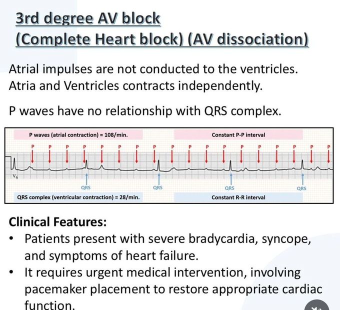 Heart Block VII