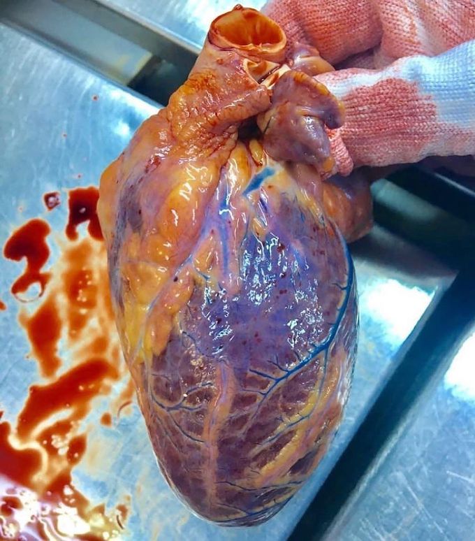 Cyanotic heart