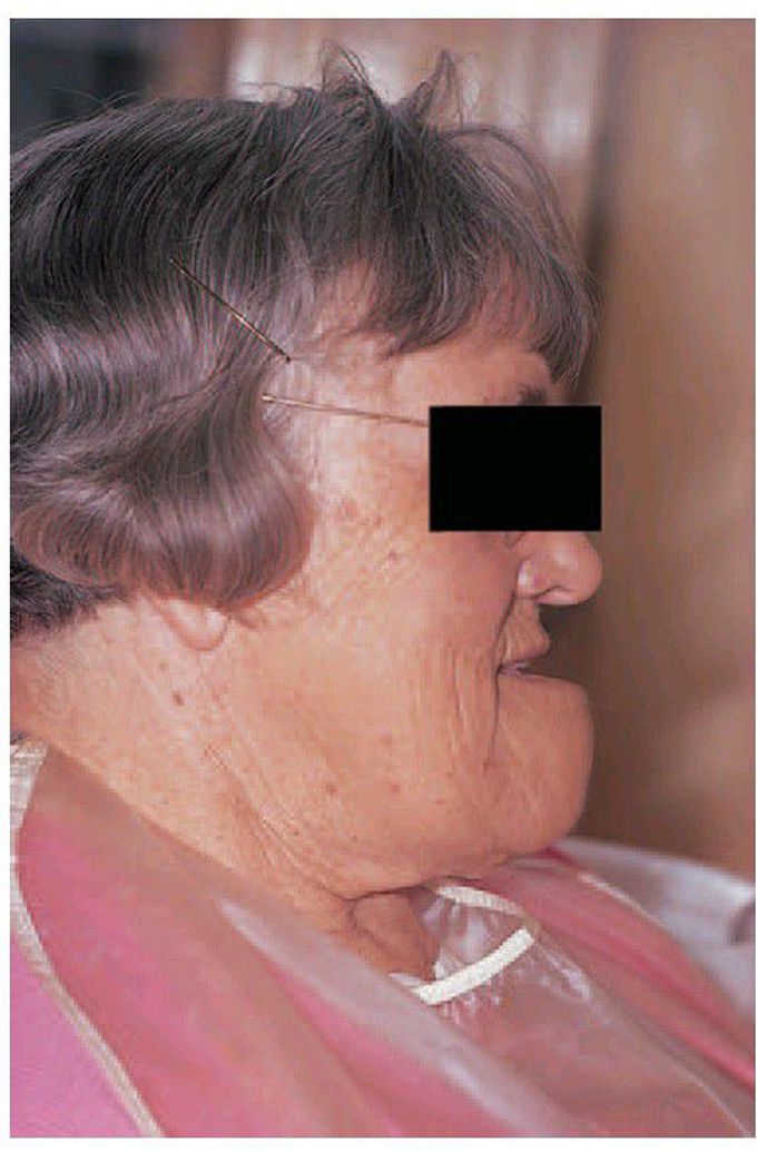 Pagets disease