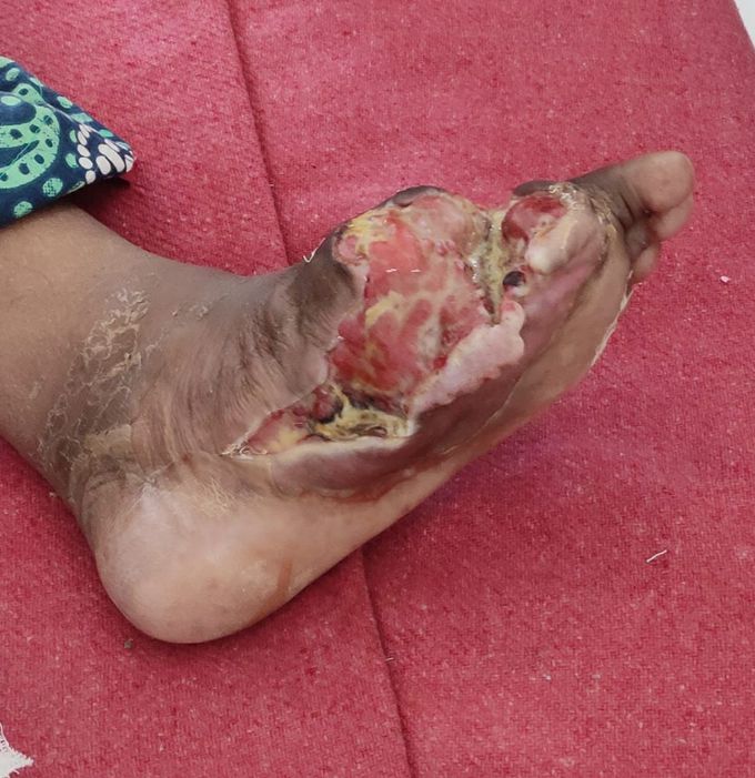 Healing ulcer