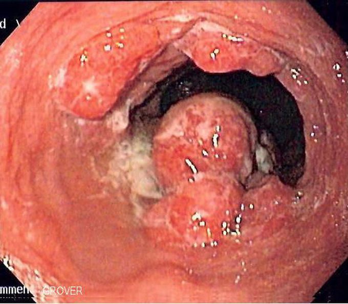 Esophageal cancer