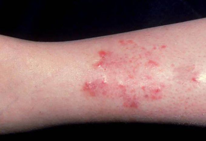 Symptoms of Stasis dermatitis