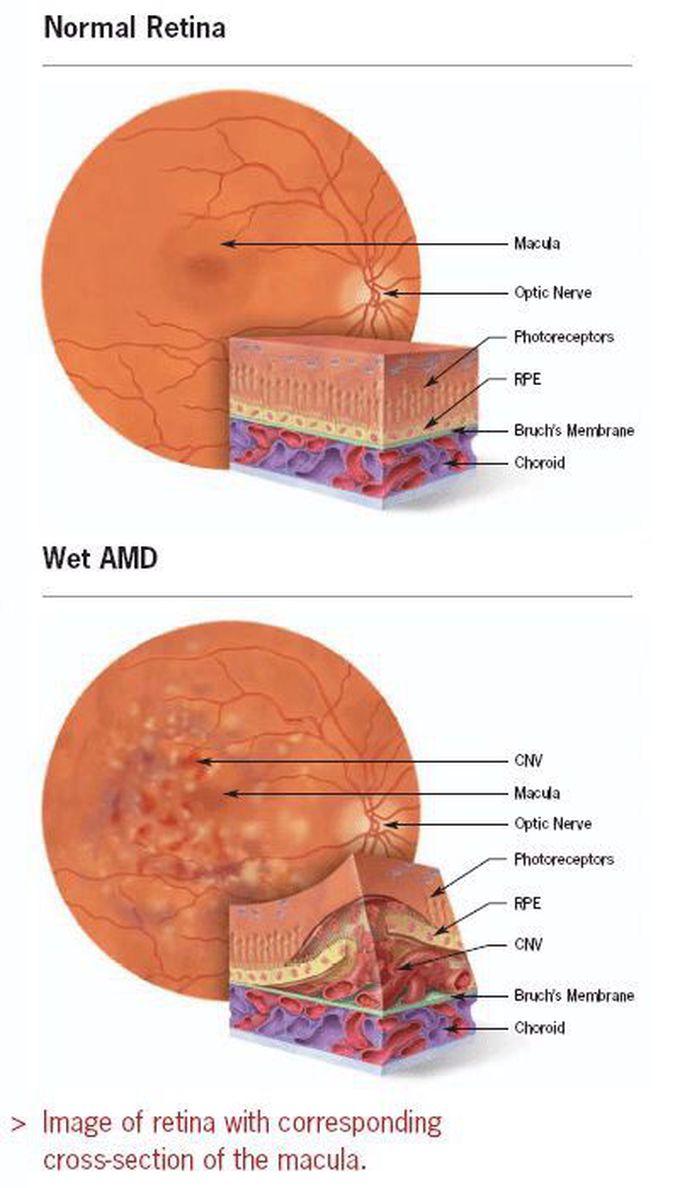 Age related macular degeneration