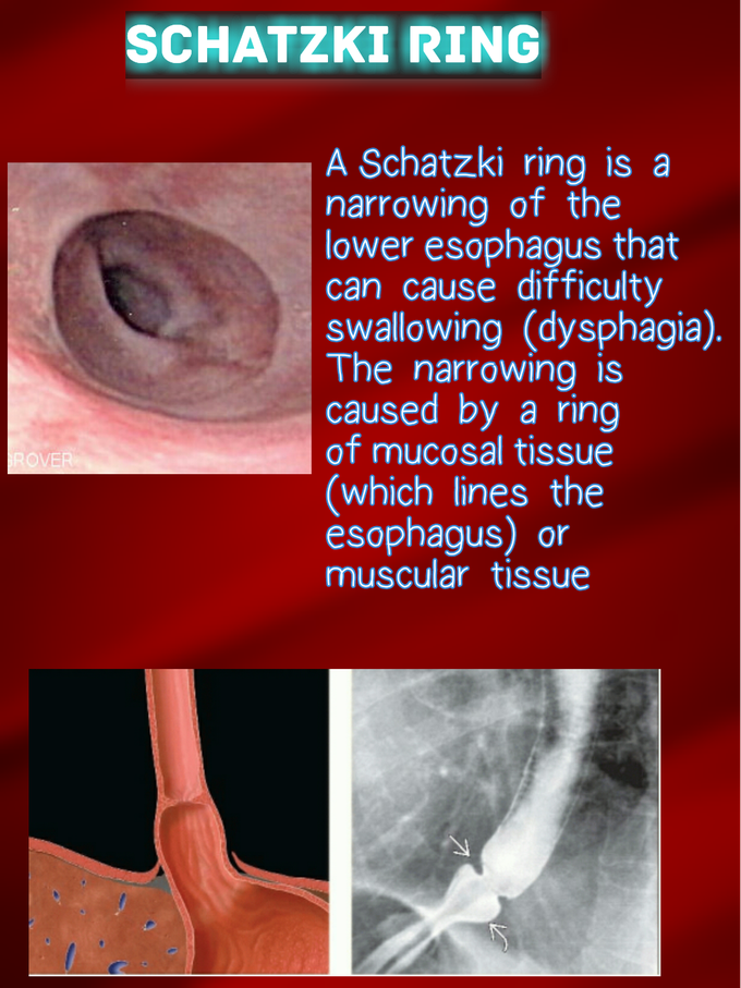 Schatzki ring