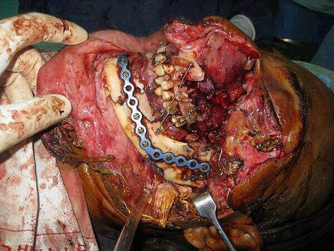 Mandibular reconstruction