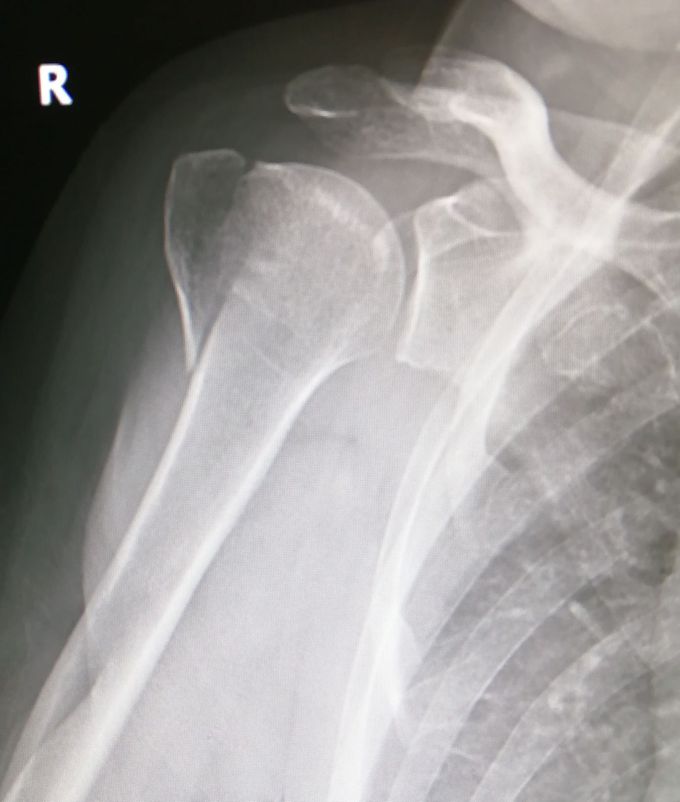 Right shoulder AP view 