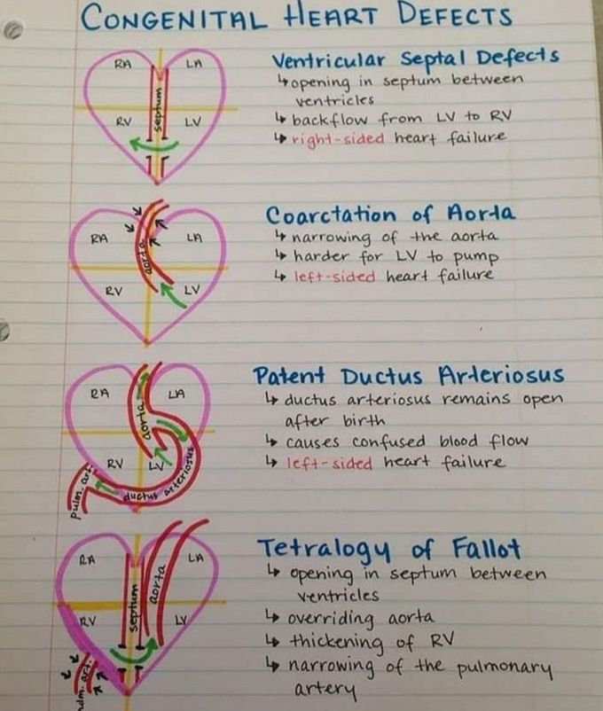 Congenital Heart Defects