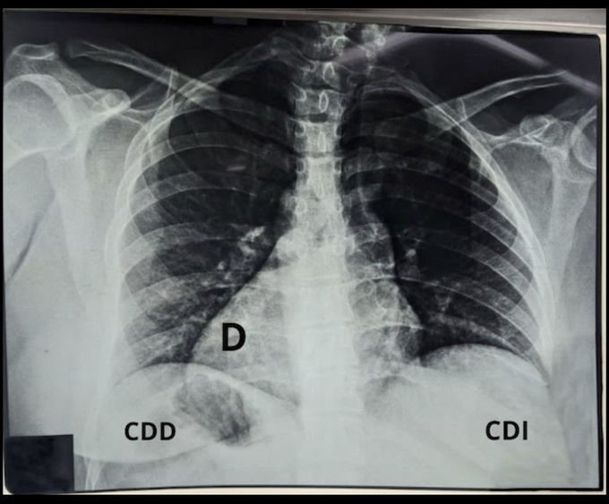 Situs Inversus Totalis