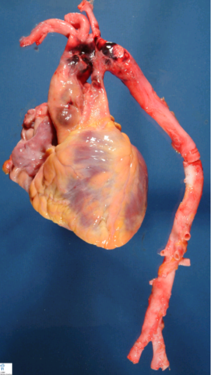 THORACIC AROTA