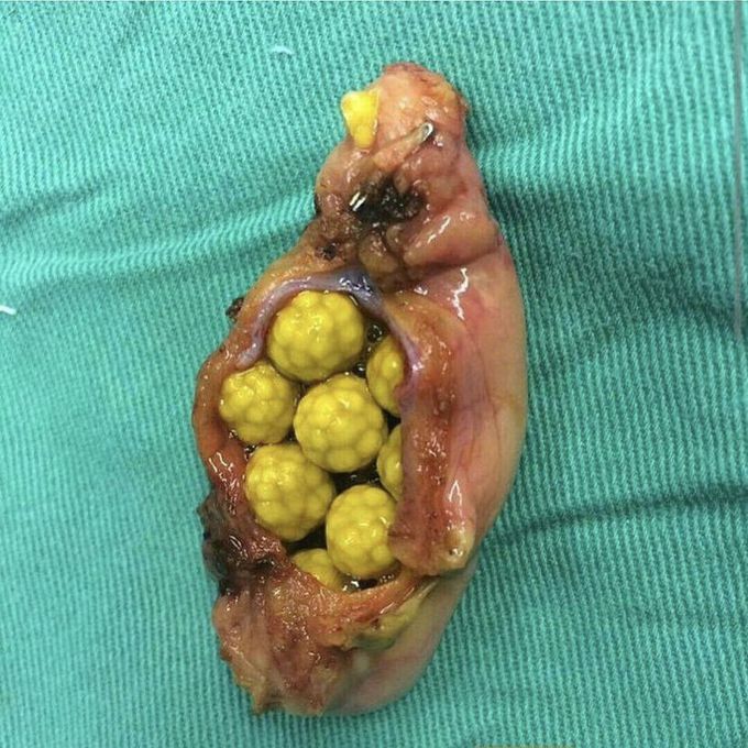 Cholelithiasis