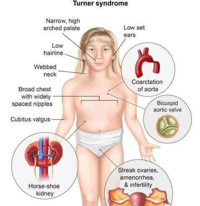 Clinical Signs of Turner Syndrome