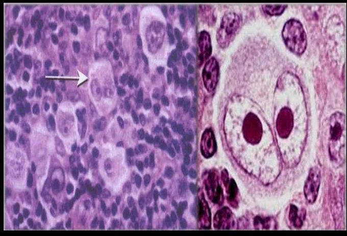 Reed sternberg cell