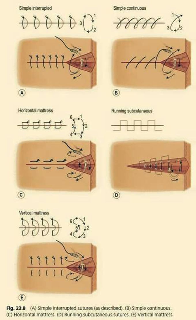 Suture types