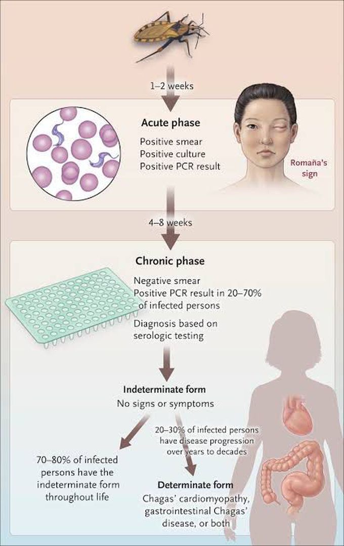 Phases of Chagas Disease