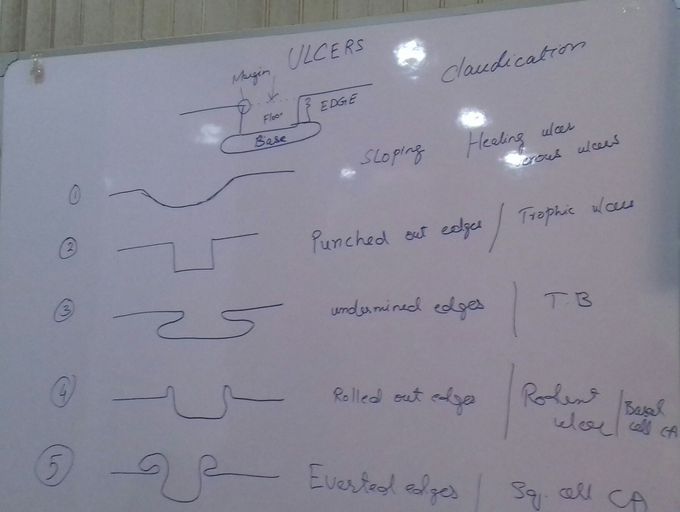 Ulcers