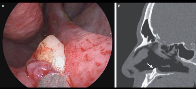 Ectopic Tooth in the Nose