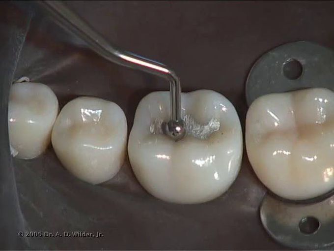 Class I Amalgam Preparation and Restoration