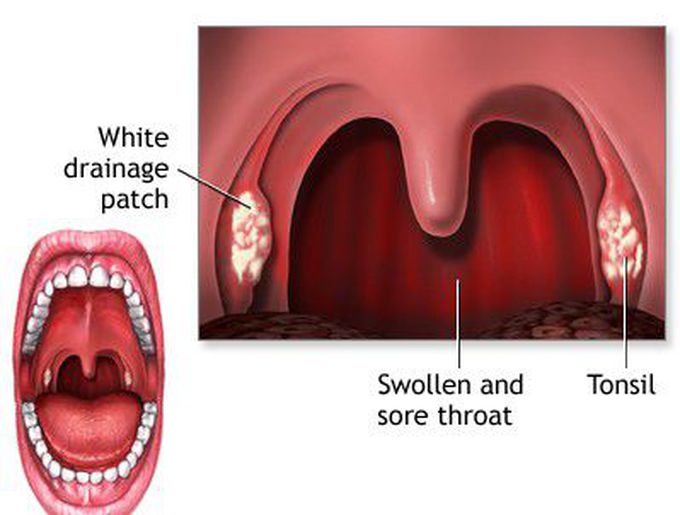 Symptoms of Tonsillitis