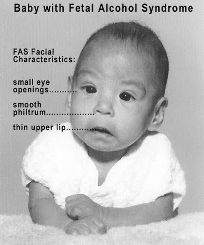 Baby with fetal alcohol spectrum disorder