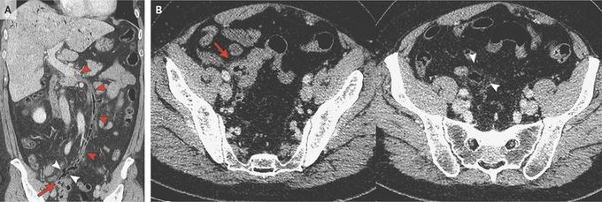 Pylephlebitis as a Complication of Diverticulitis