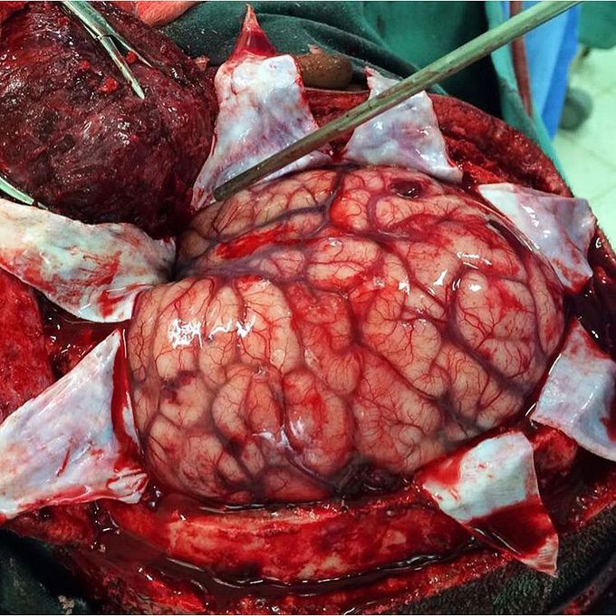 Craniectomy!!